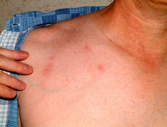 simptomi parazitov pod kožo